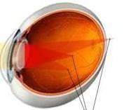 Astigmatta Gözlüksüz Görme